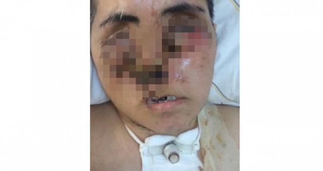 Eniştesinin saldırısı sonucu ağır yaralandı, yüzü tanınmayacak hale geldi