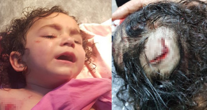 Rottweiler'ın saldırdığı 2 yaşındaki Almila ölümden döndü