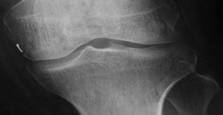 Akılalmaz olay! Bacağından çıktı