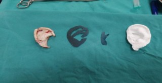 Kaburgadan yapılan yeni kulağına kavuştu